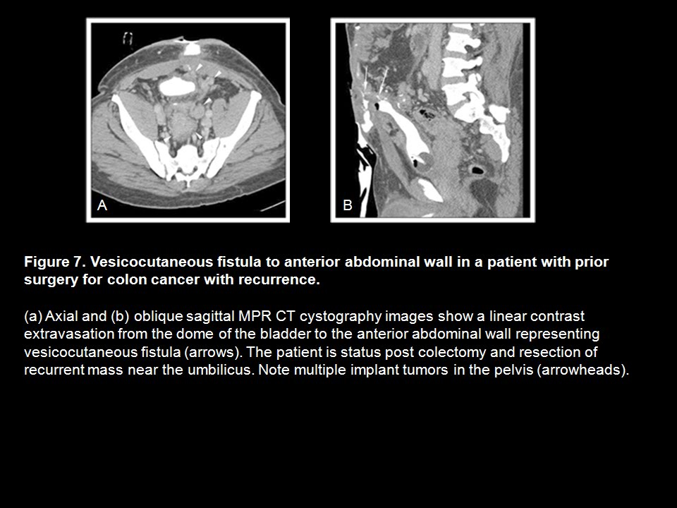 CT Cystography: The Role of 3D/MPR Imaging for Evaluation of Non-Neoplastic Disease of the Bladder