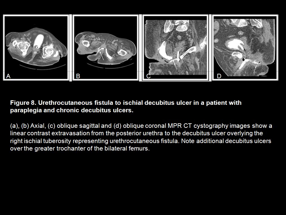 CT Cystography: The Role of 3D/MPR Imaging for Evaluation of Non-Neoplastic Disease of the Bladder