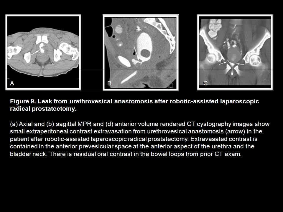 CT Cystography: The Role of 3D/MPR Imaging for Evaluation of Non-Neoplastic Disease of the Bladder