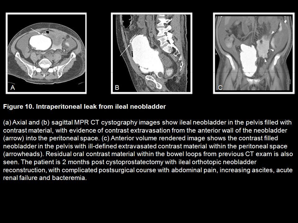 CT Cystography: The Role of 3D/MPR Imaging for Evaluation of Non-Neoplastic Disease of the Bladder