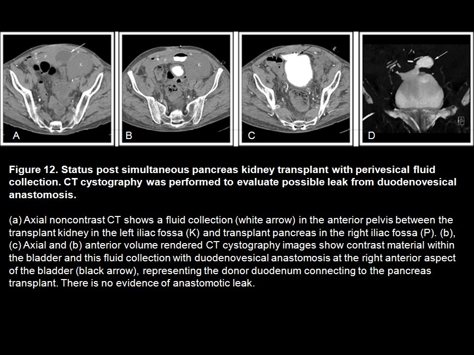 CT Cystography: The Role of 3D/MPR Imaging for Evaluation of Non-Neoplastic Disease of the Bladder