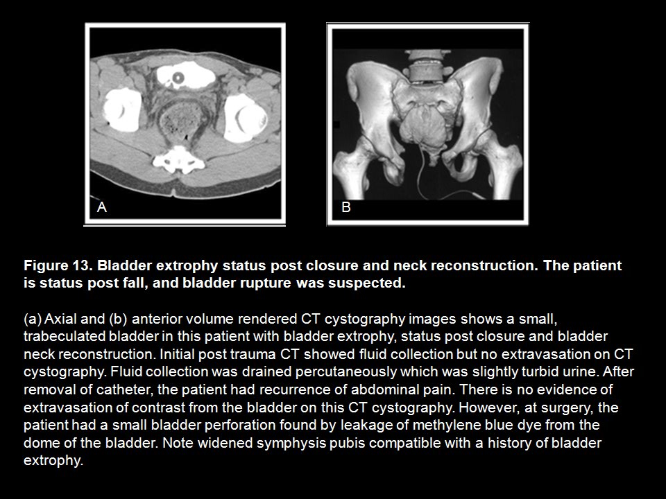 CT Cystography: The Role of 3D/MPR Imaging for Evaluation of Non-Neoplastic Disease of the Bladder