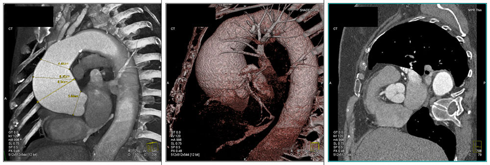 Dilated Aortic Root
