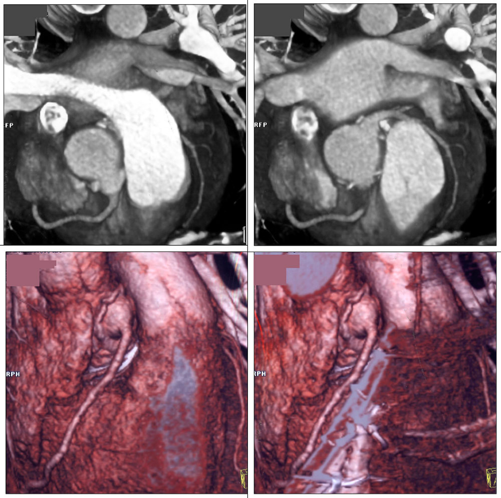 Case 6:Coronary artery aneurysms at site of implantation