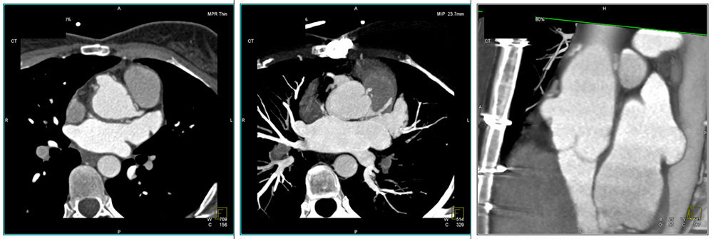 Case 7:Coronary artery aneurysms at site of implantation