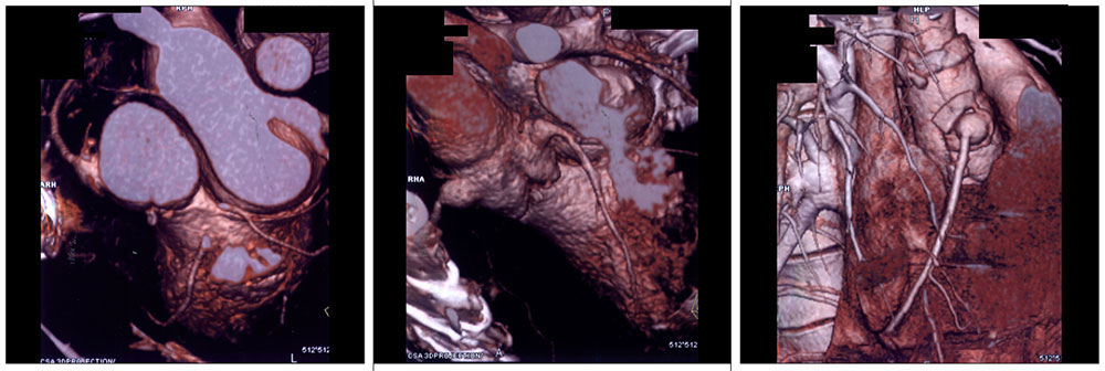 Case 7:Coronary artery aneurysms at site of implantation