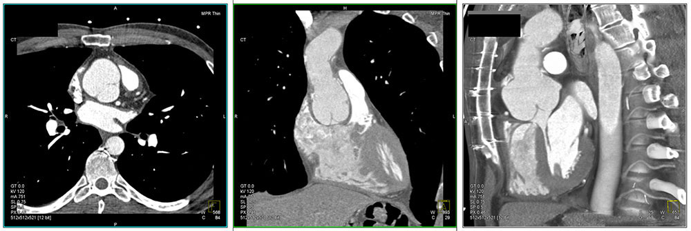 Case 9:Dilatation of the aortic sinuses and aortic root