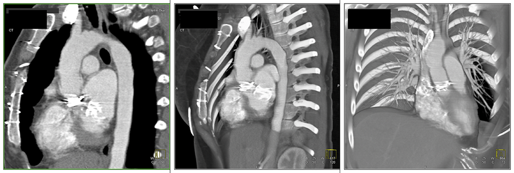 Case 1:Normal postoperative appearance in patient with composite graft and mechanical aortic valve replacement