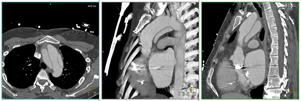 Case 4:Dissection following aortic root replacement