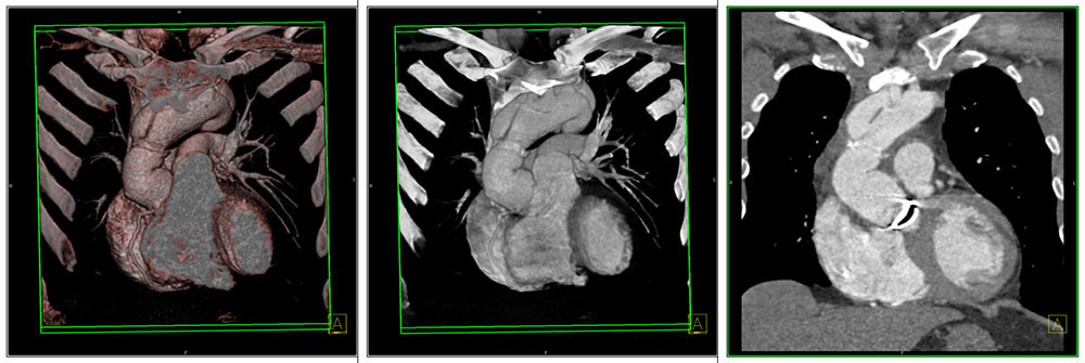 Case 5:Dissection following aortic root replacement