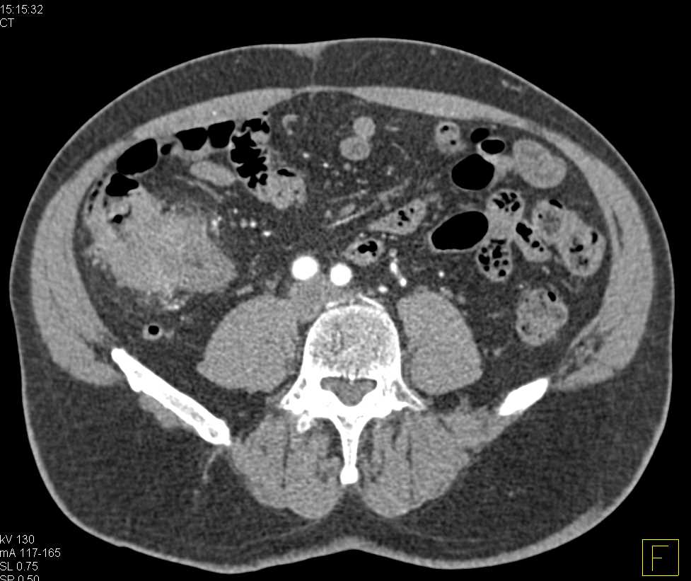 Cecal carcinoma with liver metastases colon case studies ctisus ct