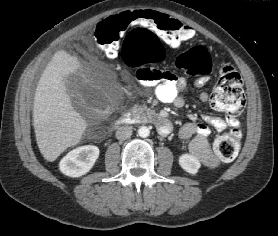 Acute Cholecystitis - Liver Case Studies - CTisus CT Scanning