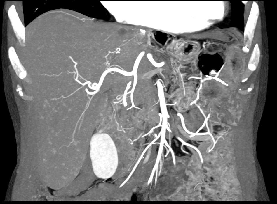 Vascular Lesions in the Liver - Liver Case Studies - CTisus CT Scanning