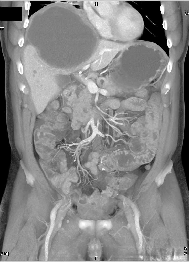 Cystic Cholangiocarcinoma - Liver Case Studies - CTisus CT Scanning