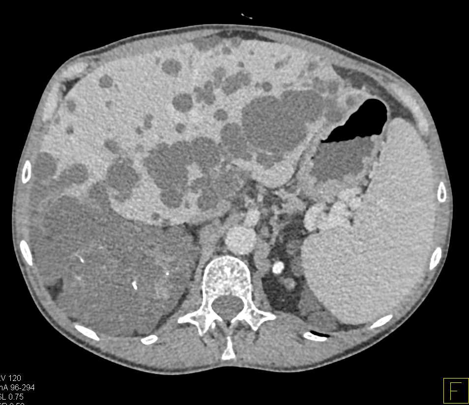 Polycystic Kidney And Liver Disease Liver Case Studies CTisus CT 