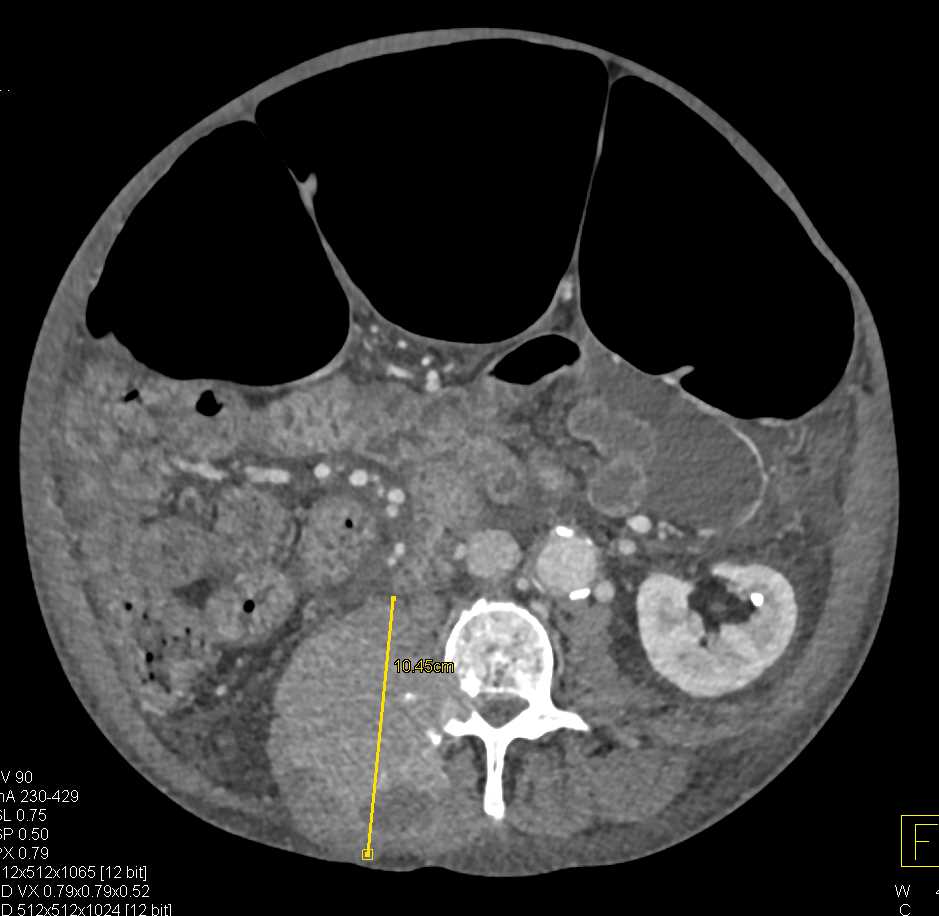 Renal Cell Carcinoma Metastatic to the L3 Vertebral Body ...