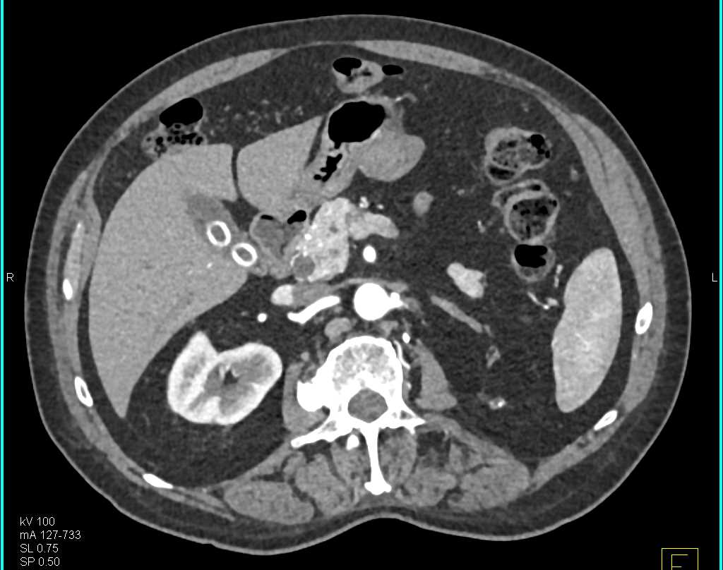 Gastric Duplication Cyst - Stomach Case Studies - CTisus CT Scanning