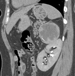 Cystic Primary Adrenal Carcinoma - CTisus CT Scan