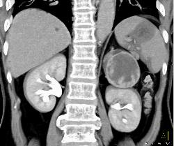 Cystic Primary Adrenal Carcinoma - CTisus CT Scan