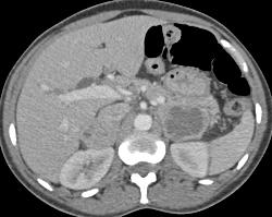 Bilateral Pheochromocytomas in A Patient With Neurofibromatosis - CTisus CT Scan