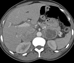 Bilateral Pheochromocytomas in A Patient With Neurofibromatosis - CTisus CT Scan