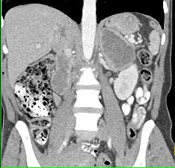 Bilateral Pheochromocytomas in A Patient With Neurofibromatosis - CTisus CT Scan