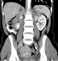 Bilateral Pheochromocytomas in A Patient With Neurofibromatosis - CTisus CT Scan