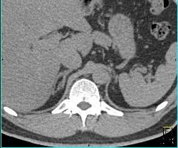 1 Cm Adenoma - CTisus CT Scan