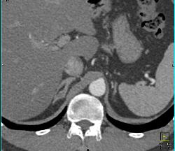 1 Cm Adenoma - CTisus CT Scan