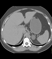 Adrenal Adenoma - CTisus CT Scan