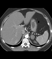 Adrenal Adenoma - CTisus CT Scan