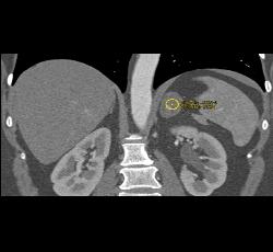 Adrenal Adenoma - CTisus CT Scan