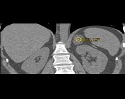 Adrenal Adenoma - CTisus CT Scan