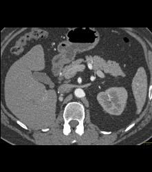 Metastatic Renal Cell Carcinoma to the Right Adrenal - CTisus CT Scan