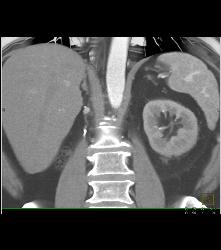 Metastatic Renal Cell Carcinoma to the Right Adrenal - CTisus CT Scan