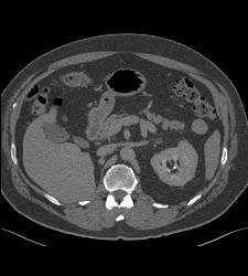 Metastatic Renal Cell Carcinoma to the Right Adrenal - CTisus CT Scan