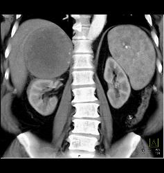 Unusual Case of Old Adrenal Hematoma - CTisus CT Scan