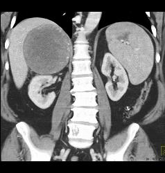 Unusual Case of Old Adrenal Hematoma - CTisus CT Scan