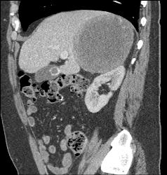 Unusual Case of Old Adrenal Hematoma - CTisus CT Scan