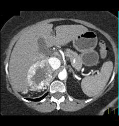 Renal Cell Carcinoma With Adrenal Metastases - CTisus CT Scan