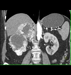 Renal Cell Carcinoma With Adrenal Metastases - CTisus CT Scan