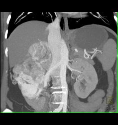 Renal Cell Carcinoma With Adrenal Metastases - CTisus CT Scan