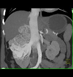 Renal Cell Carcinoma With Adrenal Metastases - CTisus CT Scan