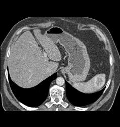 Recurrent Renal Cell Carcinoma Is Metastatic to the Spleen, Adrenal, and Bone - CTisus CT Scan