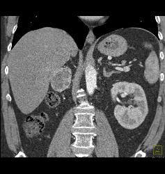 Recurrent Renal Cell Carcinoma Is Metastatic to the Spleen, Adrenal, and Bone - CTisus CT Scan