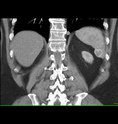 Recurrent Renal Cell Carcinoma Is Metastatic to the Spleen, Adrenal, and Bone - CTisus CT Scan