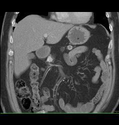 Recurrent Renal Cell Carcinoma Is Metastatic to the Spleen, Adrenal, and Bone - CTisus CT Scan