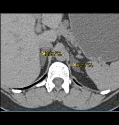 Adrenal Adenomas - CTisus CT Scan