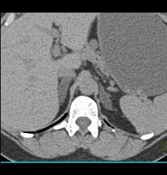 Adrenal Adenomas - CTisus CT Scan