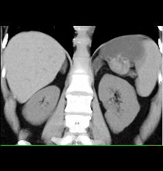 Adrenal Adenomas - CTisus CT Scan